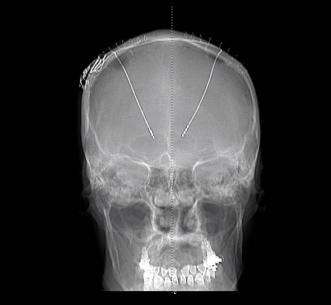 Brain surgery DBS leads