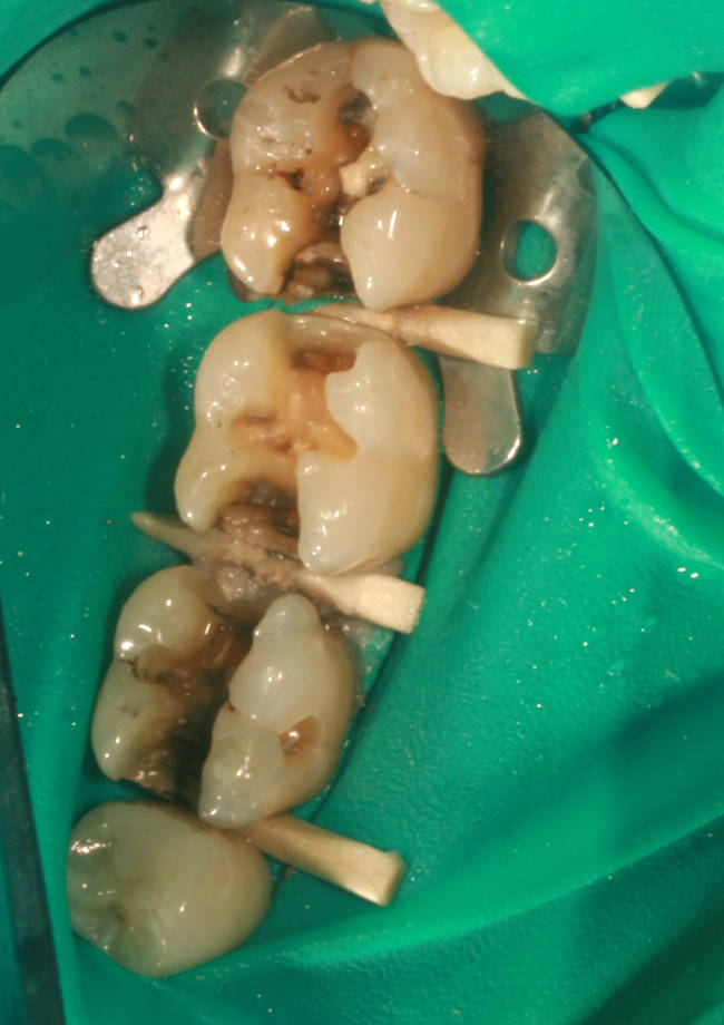 amalgam removed