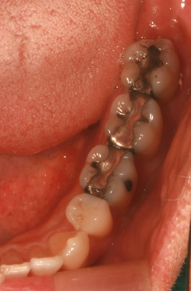 amalgam fillings