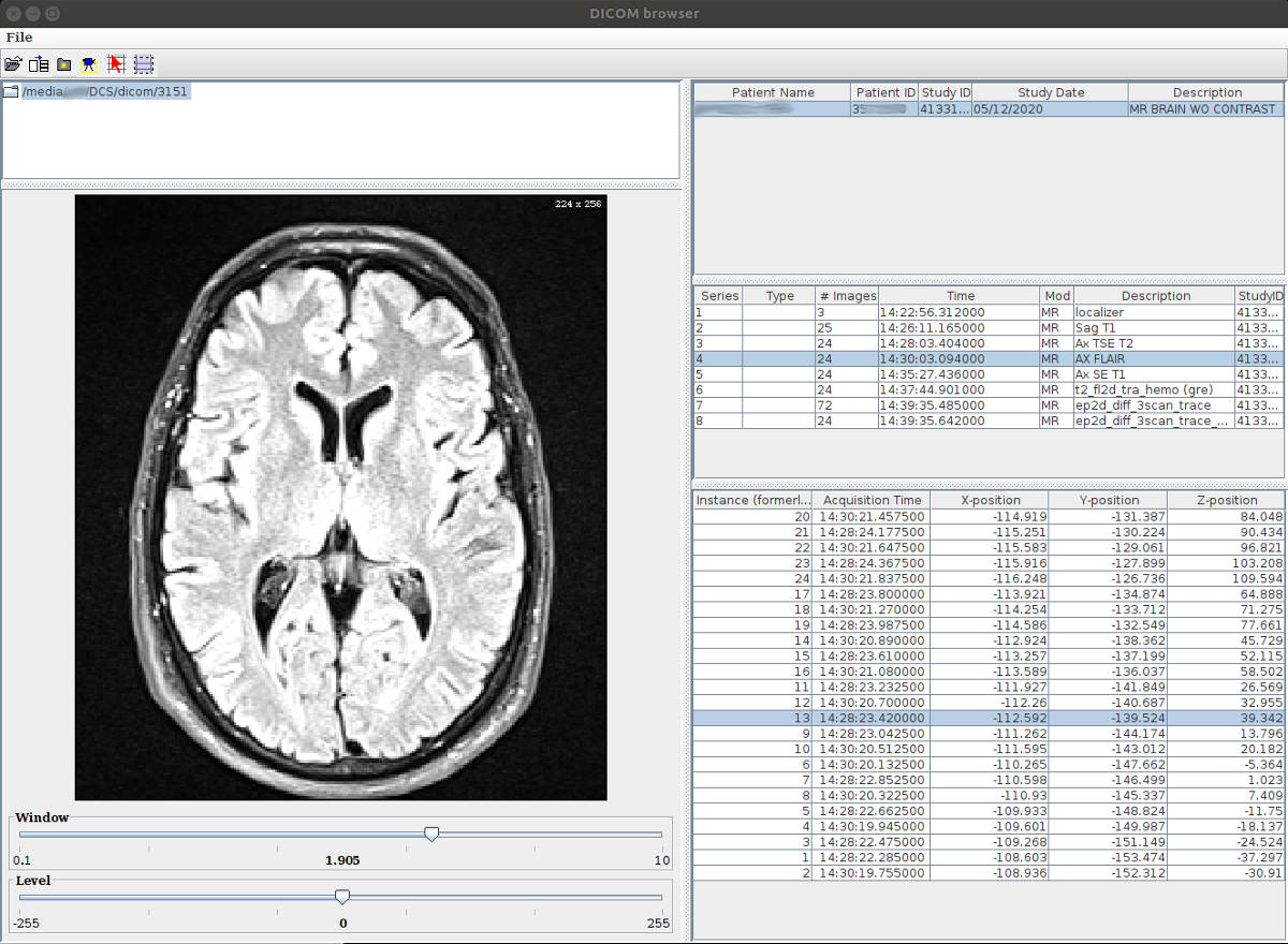 MRI Brain