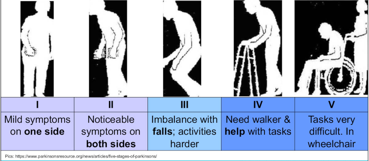 Five stages of Parkinsons disease